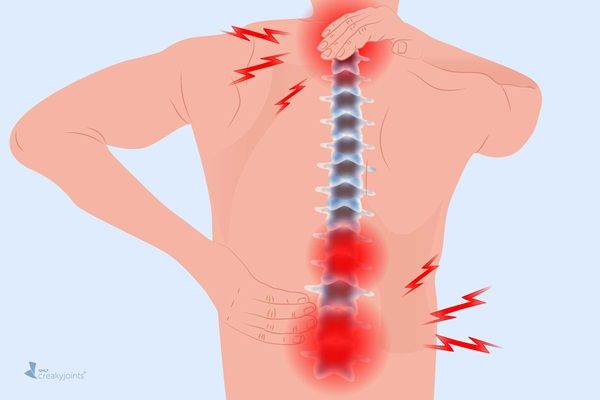 Các cách giảm đau lưng do viêm khớp dạng thấp