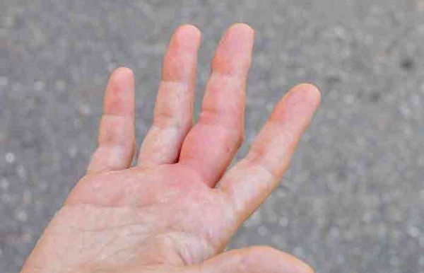 Các triệu chứng viêm khớp ở ngón tay