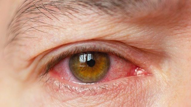 Viêm khớp dạng thấp ảnh hưởng như thế nào đến mắt?
