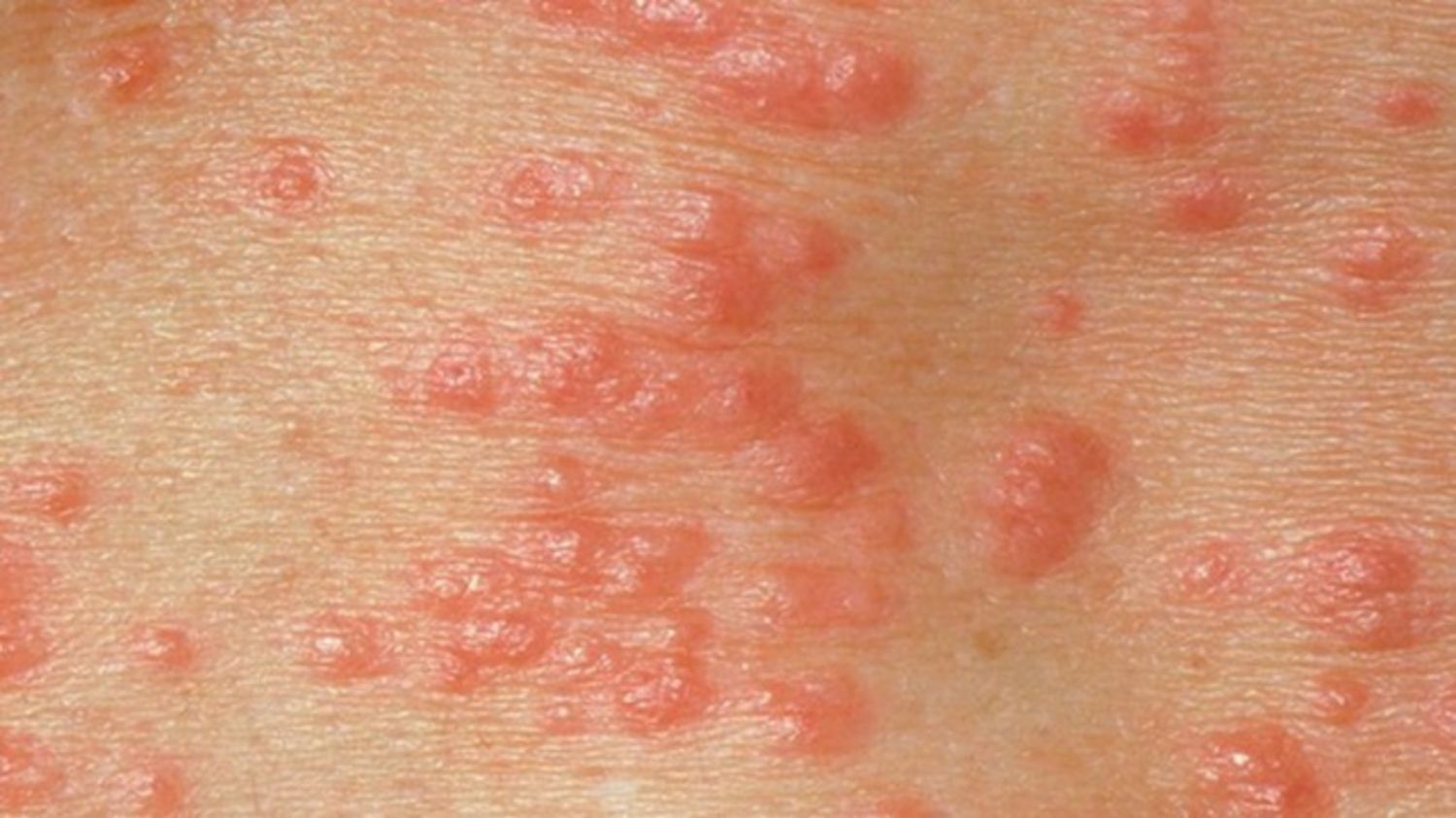 Da nổi mẩn có phải triệu chứng herpes không?