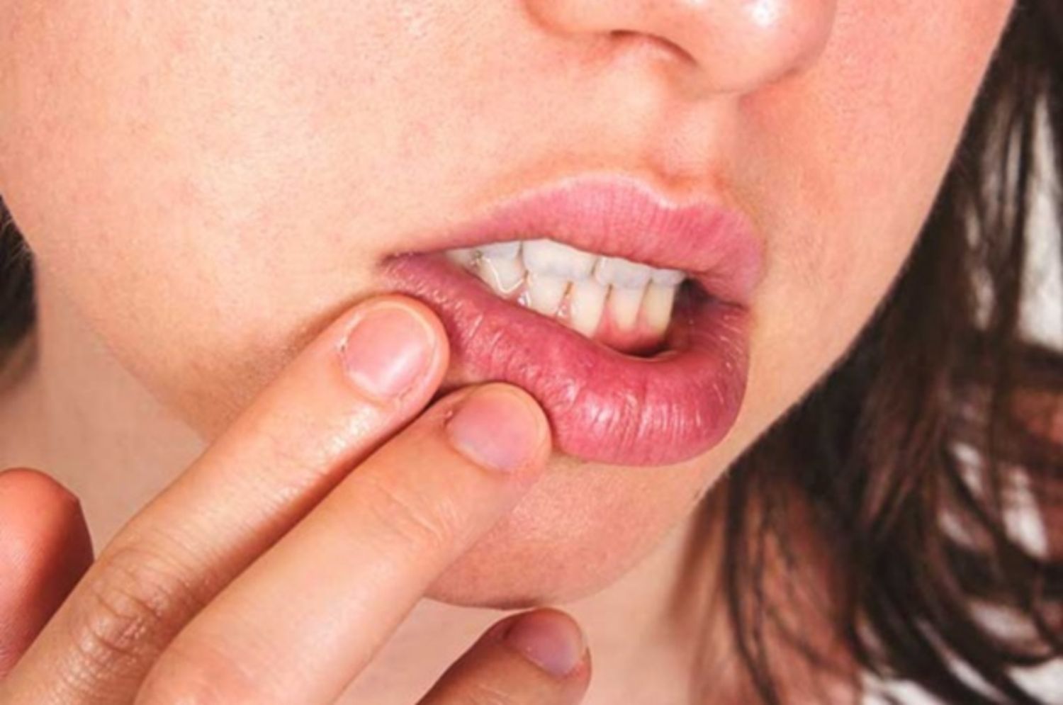 Các giai đoạn herpes ở môi