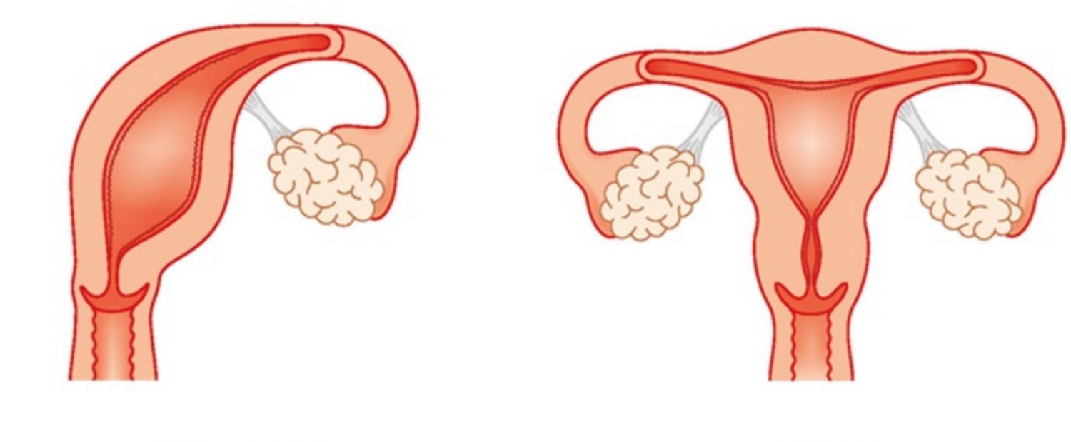 Tử cung một sừng (bên trái) và tử cung bình thường (bên phải)