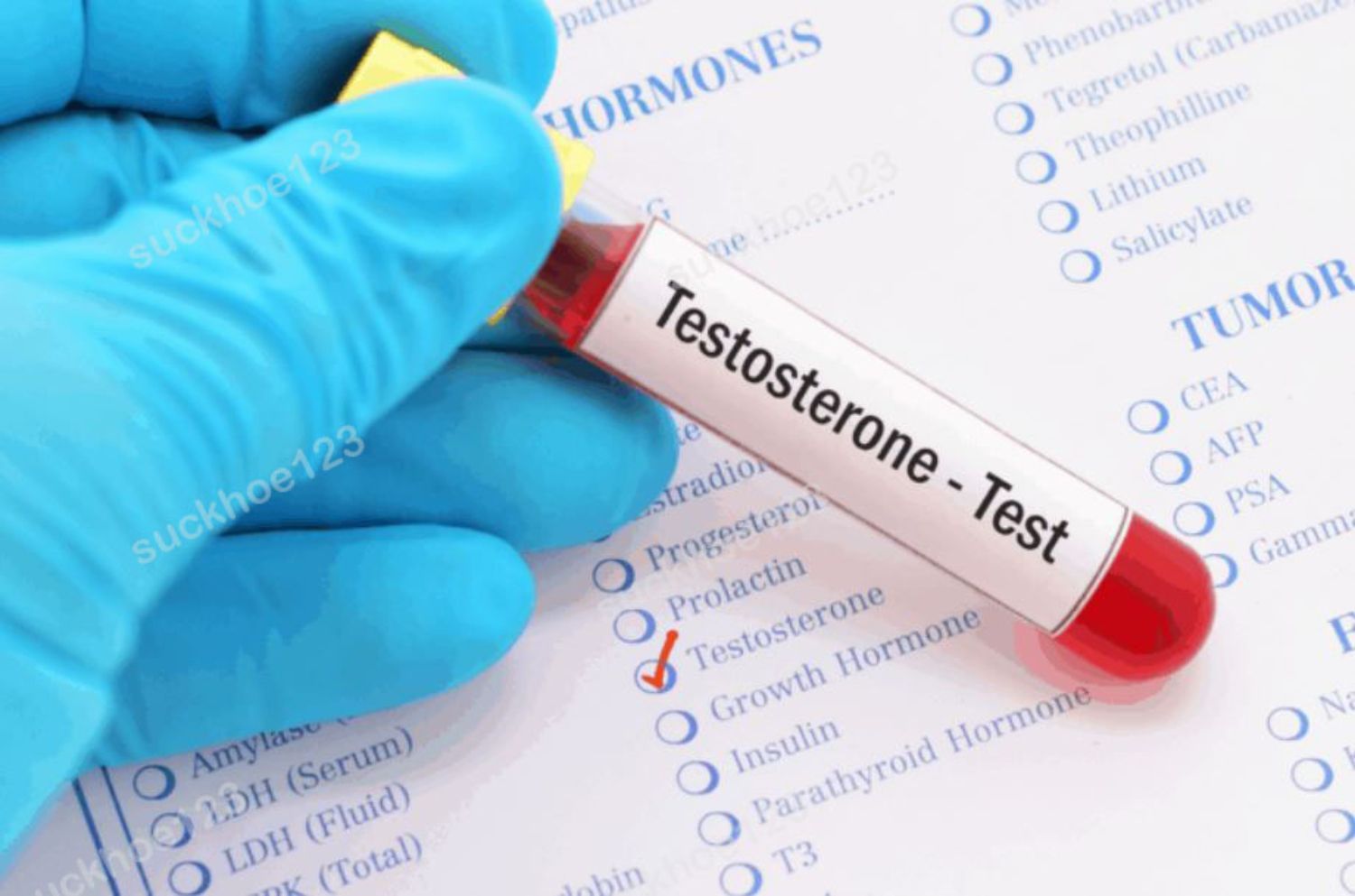 Khi nào nên xét nghiệm Testosterone?