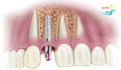 Công nghệ trồng răng Implant giải pháp hoàn hảo cho hàm răng đẹp! - Nha khoa Lạc Việt