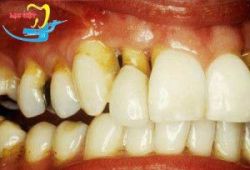 Nguyên nhân bệnh đau răng hàm trên và cách điều trị - Nha khoa Lạc Việt