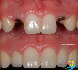 Làm răng implant cho răng cửa - Nha khoa Lạc Việt