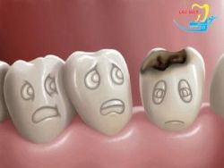 Tổng hợp cách ngừa sâu răng hiệu quả nhất – XEM NGAY - Nha khoa Lạc Việt