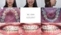 Sửa lại một ca niềng răng hỏng, khớp cắn sai, hô hàm trên - Bác sĩ Việt Anh