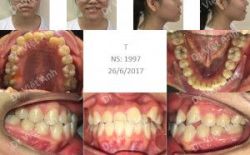 Niềng răng móm, khấp khểnh trong 12 tháng - Bác sĩ Việt Anh