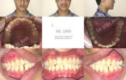 Sự thay đổi ngoạn mục sau khi niềng răng móm, thưa hàm dưới - Bác sĩ Việt Anh