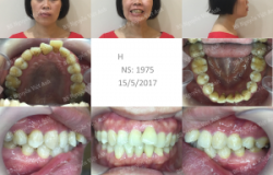 Niềng răng khấp khểnh, thiếu răng cửa dưới - Bác sĩ Việt Anh