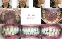 Niềng răng thưa hàm dưới sau 7 tháng, khớp cắn hài hòa - Bác sĩ Việt Anh