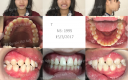 Nụ cười hoàn hảo sau khi niềng răng thưa - Bác sĩ Việt Anh
