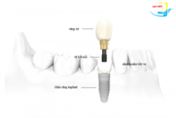 Răng implant bị lung lay, nguyên nhân và cách khắc phục - Nha khoa Lạc Việt