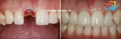Răng implant tồn tại được bao lâu - Nha khoa Lạc Việt