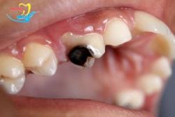 Sâu răng hàm rất nguy hiểm và phải điều trị dứt điểm - Nha khoa Lạc Việt