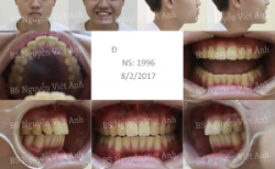 Sửa ca niềng răng bị chìa bằng cách kéo lùi toàn bộ hàm - Bác sĩ Việt Anh