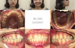Niềng răng móm sau 13 tháng bằng mắc cài mặt trong- Bác sĩ Việt Anh