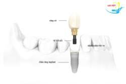 Những vấn đề thường gặp của răng implant - Nha khoa Lạc Việt