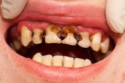 Biện pháp chăm sóc răng miệng tránh sún răn g ở trẻ - Nha khoa Đăng Lưu