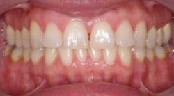 Nguyên nhân gây bệnh thiếu sản men răng - Nha khoa Đăng Lưu