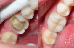 Cách khắc phục răng bị mẻ đơn giản và tiết kiệm - Nha khoa Đăng Lưu