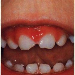 Cách nhận biết viêm lợi có mủ - Nha khoa Đăng Lưu