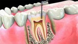 Nguyên nhân và triệu chứng của bệnh viêm tủy - Nha khoa Đăng Lưu răng