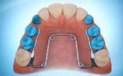 Khí cụ giúp răng mọc đúng vị trí khi răng sữa mất sớm - Nha khoa Đăng Lưu
