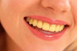 Nguyên nhân khiến răng bị ố vàng - Nha khoa Đăng Lưu