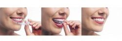 Phương pháp niềng răng không mắc cài Invisalign - Nha khoa Đăng Lưu