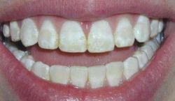 Cách bổ sung Fluor cho răng miệng - Nha khoa Đăng Lưu