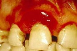 Nguy hiểm tiềm ẩn từ bệnh viêm tủy răng - Nha khoa Đăng Lưu