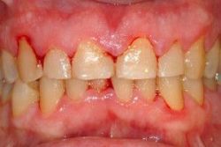 Mẹo chữa viêm chân răng hiệu quả tại nhà - Nha khoa Đăng Lưu