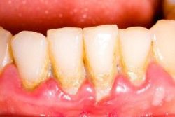 Bệnh nha chu không chỉ gây mất răng - Nha khoa Đăng Lưu