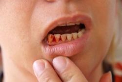 Chữa viêm chân răng bằng thuốc nam - Nha khoa Đăng Lưu