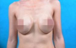 Làm thế nào để tránh co thắt bao xơ khi nâng ngực - Bệnh viện thẩm mỹ JW Hàn Quốc