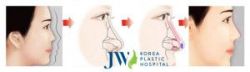Sửa mũi bao nhiêu tiền và có biến chứng gì không? - Bệnh viện thẩm mỹ JW Hàn Quốc