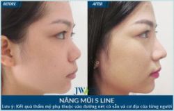 Nâng mũi bằng sụn vành tai ngăn ngừa hiệu quả mọi biến chứng - Bệnh viện thẩm mỹ JW Hàn Quốc