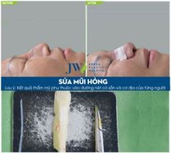 Những biến chứng sau phẫu thuật nâng mũi thường gặp - Bệnh viện thẩm mỹ JW Hàn Quốc
