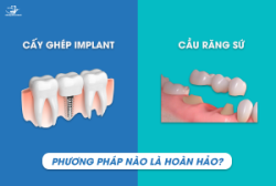 Trồng răng implant và cầu răng sứ là hai phương pháp phục hồi răng được nhiều bệnh nhân lựa chọn.