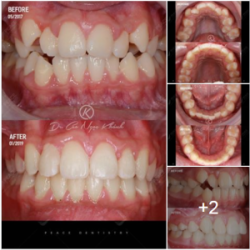 CA LÂM SÀNG: Niềng răng mắc cài tự buộc (self-ligating) cho răng chen chúc, khớp cắn hạng 1, kết hợp nong 2 hàm…tháo niềng sau 20 tháng.