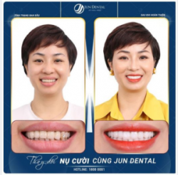 Chỉ sau 48h, đôi bàn tay vàng của bác sĩ Jun Dental khởi tạo nụ cười từ sự tinh tế, tỉ mỉ, chuẩn xác đến từng chi tiết.