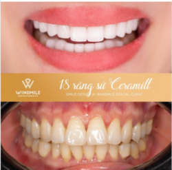 HOÀN THIỆN NỤ CƯỜI CHUẨN SAO CÙNG TUYỆT TÁC RĂNG SỨ CERAMILL