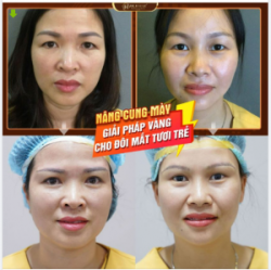 Bạn có đang gặp phải tình trạng mà 100 người phụ nữ có đến 80% sụp mí tuổi ngoài 30?