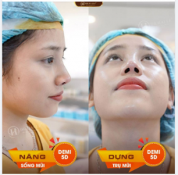 BÍ MẬT TẠO NÊN MỘT CHIẾC MŨI ĐẸP