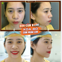 Cằm xinh - Ngắm góc mặt nào cũng xinh