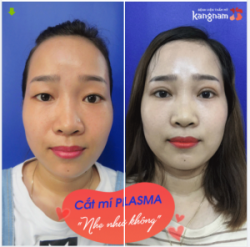 Cắt mí "nặng tiền, tốn thời gian​​​​​​​ KHÔNG HỀ
