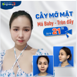 Cấy mỡ mặt - Trẻ đẹp ngay sau làm Chỉ từ 21TR