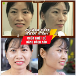 Chàm bớt bẩm sinh có chữa dứt điểm được không? Điều trị bằng phương pháp nào hiệu quả hiện nay